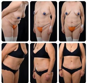 Before and after tummy tuck results at Yurchenko Plastic Surgery Team, improved abdominal contour
