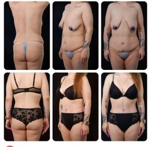 Before and after tummy tuck results at Yurchenko Plastic Surgery Team, body contour improved