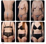 Before and after tummy tuck results at Yurchenko Plastic Surgery Team, body contour improved
