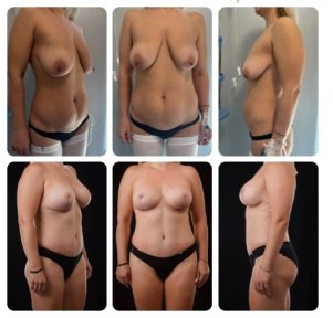 Before and after tummy tuck results at Yurchenko Plastic Surgery Team, improved abdominal contour