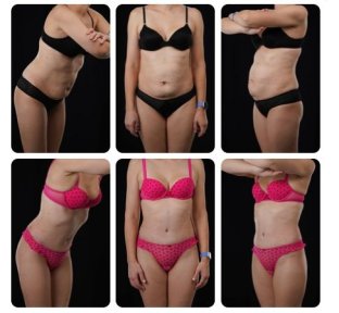 Before and after tummy tuck results at Yurchenko Plastic Surgery Team, visible flatter abdomen