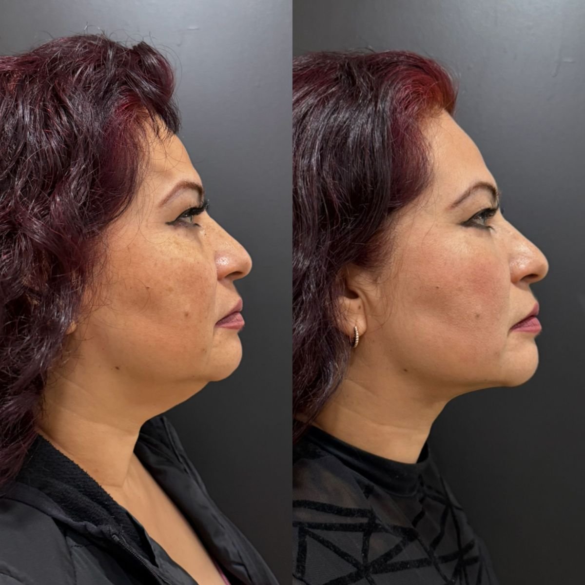 Resultados de lifting de cuello antes y después – mejora del contorno mandibular y cuello