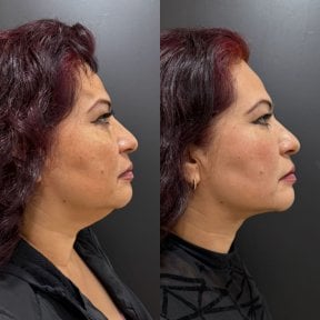Before and after neck lift results – improved jawline and neck contour after procedure