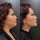 Before and after neck lift results – improved jawline and neck contour after procedure