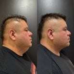Before and after neck lift results – improved jawline and reduced neck fullness