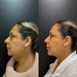 Before and after neck lift results – improved jawline and tighter neck skin