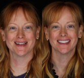 Before and after Hollywood Smile at Estemarley – dental veneers for a brighter, even smile result