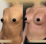 Vorher-nachher-Ergebnis Brustvergrößerung mit Eigenfett in der Dr. Safa Manav Klinik