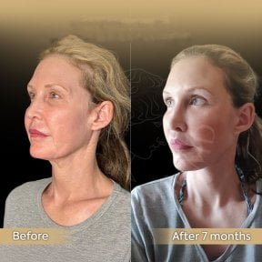 Before and after neck lift results at Dr. Safa Manav Clinic, visible jawline and neck contour