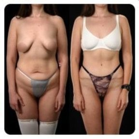 Before and after tummy tuck results at Yurchenko Plastic Surgery Team, improved abdominal contour