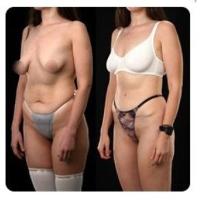 Before and after tummy tuck results at Yurchenko Plastic Surgery Team, improved abdomen contour