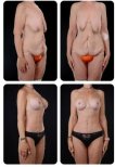 Before and after tummy tuck and breast lift results at Yurchenko Plastic Surgery Team clinic