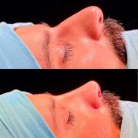 نتائج تجميل الأنف قبل وبعد في Estemarley، تحسين شكل الأنف والملف الجانبي