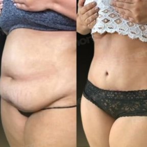Vorher-nachher-Ergebnis der Vaser-Liposuktion am Bauch im Memorial Göztepe Hospital