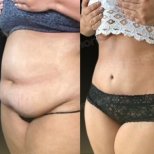 Vorher-nachher-Ergebnis der Vaser-Liposuktion am Bauch im Memorial Göztepe Hospital