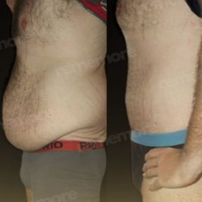 Vorher-nachher-Ergebnis Vaser-Liposuktion am Memorial Göztepe Hospital, Bauchkontur