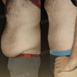Vorher-nachher-Ergebnis Vaser-Liposuktion am Memorial Göztepe Hospital, Bauchkontur