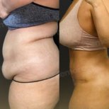 Vorher-nachher-Ergebnis Vaser-Liposuktion am Bauch in Memorial Göztepe Hospital