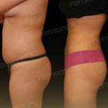 Vorher-nachher-Ergebnis Vaser-Liposuktion bei Memorial Göztepe Hospital, Körperkontur