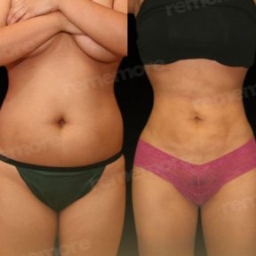 Vorher-nachher-Ergebnis Vaser-Liposuktion bei Memorial Göztepe Hospital, verbesserte Körperkontur