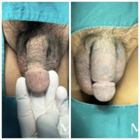 Resultados antes y después de aumento de pene en Menness Wellness Clinic, mayor tamaño visible