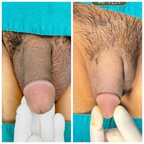 Before and after penis botox results at Menness Wellness Clinic, improved skin tone and texture