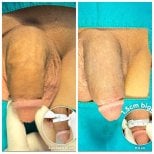 Before and after penis botox results at Menness Wellness Clinic, visible length enhancement