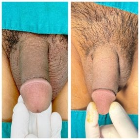 Resultados antes y después de relleno de pene en Menness Wellness Clinic, mayor grosor visible