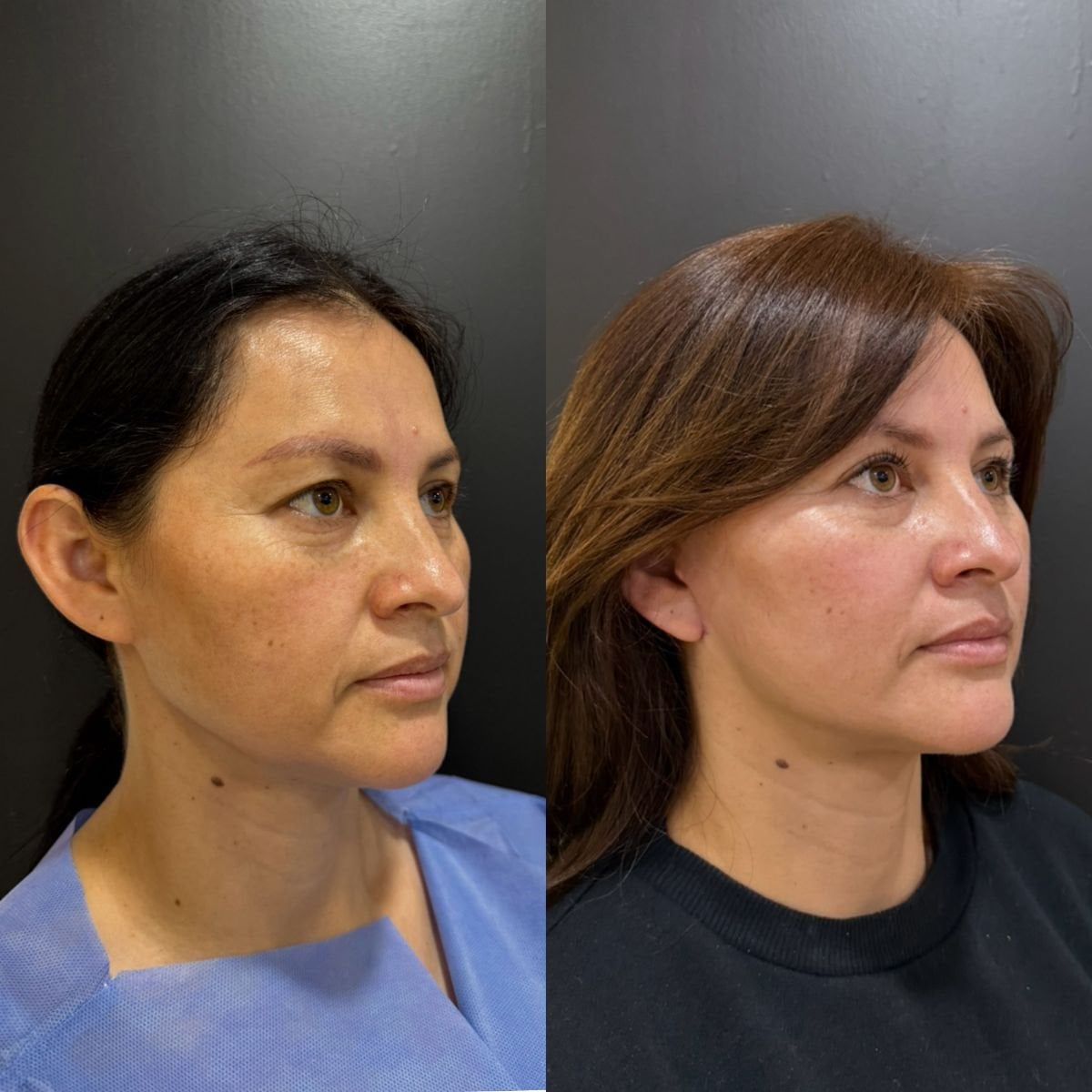 Before and after mini facelift results – facial rejuvenation and tighter skin outcome