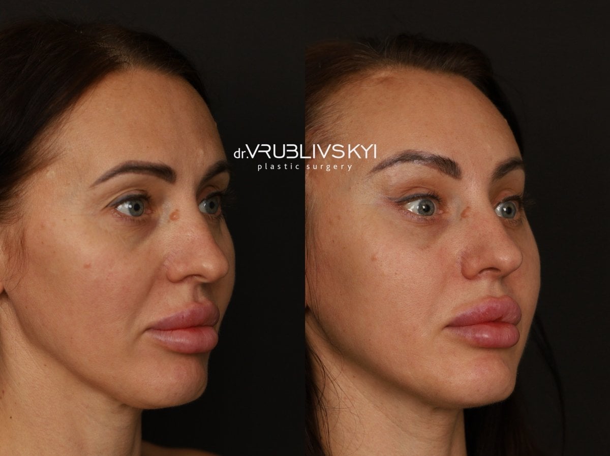 Resultados de lifting facial antes y después en Dr. VRUBLIVSKYI Plastic Surgery, rejuvenecimiento