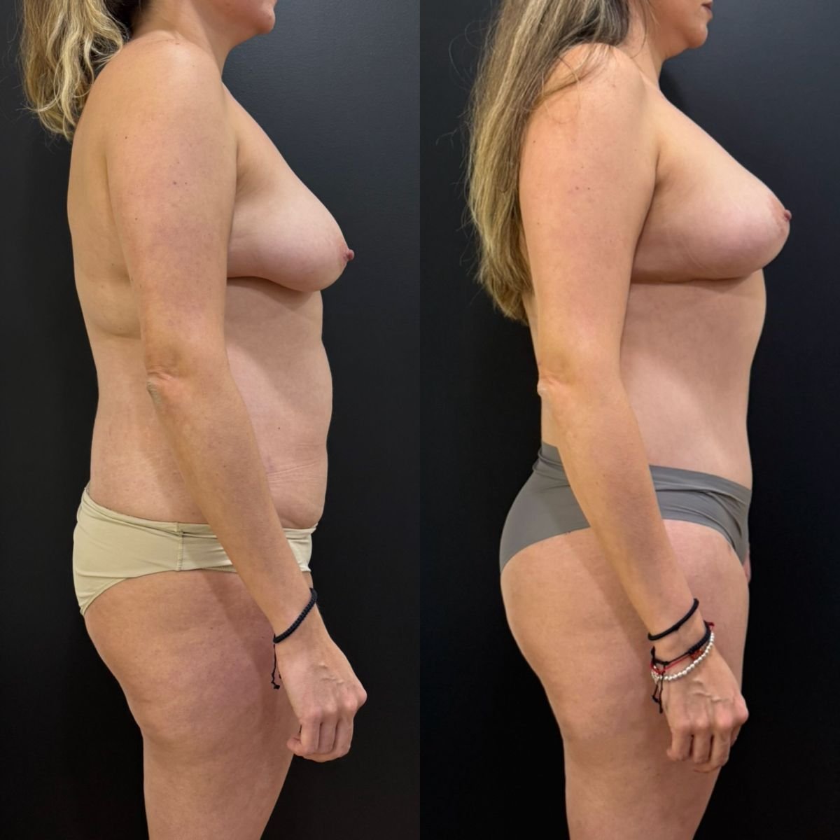 Resultados antes y después de mommy makeover – mejora de contorno corporal y pecho