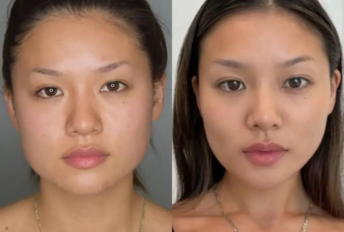 Before and after buccal fat extraction results – slimmer cheeks and defined face contour