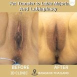 Resultados antes y después de transferencia de grasa y labioplastia en ID Clinic Bangkok