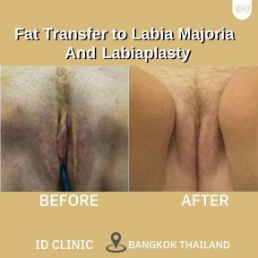 Resultados antes y después de transferencia de grasa y labioplastia en ID Clinic Bangkok