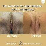 Resultados antes y después de transferencia de grasa y labioplastia en ID Clinic Bangkok