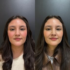 Before and after rhinoplasty results, nose reshaping with natural look at the clinic