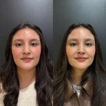 Before and after rhinoplasty results, nose reshaping with natural look at the clinic