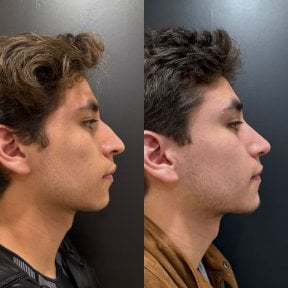 Before and after rhinoplasty results, male nose reshaping with natural profile improvement