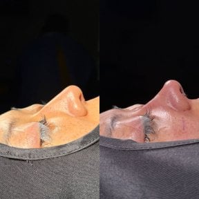 Before and after rhinoplasty results, nose reshaping with improved profile and contour