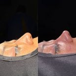 Before and after rhinoplasty results, nose reshaping with improved profile and contour
