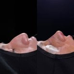 Before and after rhinoplasty results, nose reshaping profile improvement at clinic