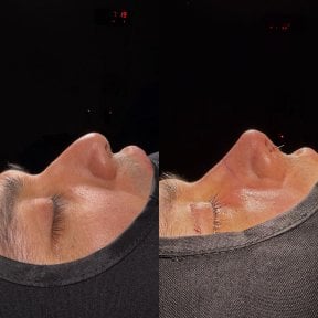 Before and after rhinoplasty results, male nose reshaping with improved nasal profile