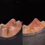 Before and after rhinoplasty results, male nose reshaping with improved nasal profile