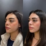 Before and after rhinoplasty results, nose reshaping with natural look at the clinic