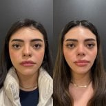 Before and after rhinoplasty results, nose reshaping with natural look at the clinic