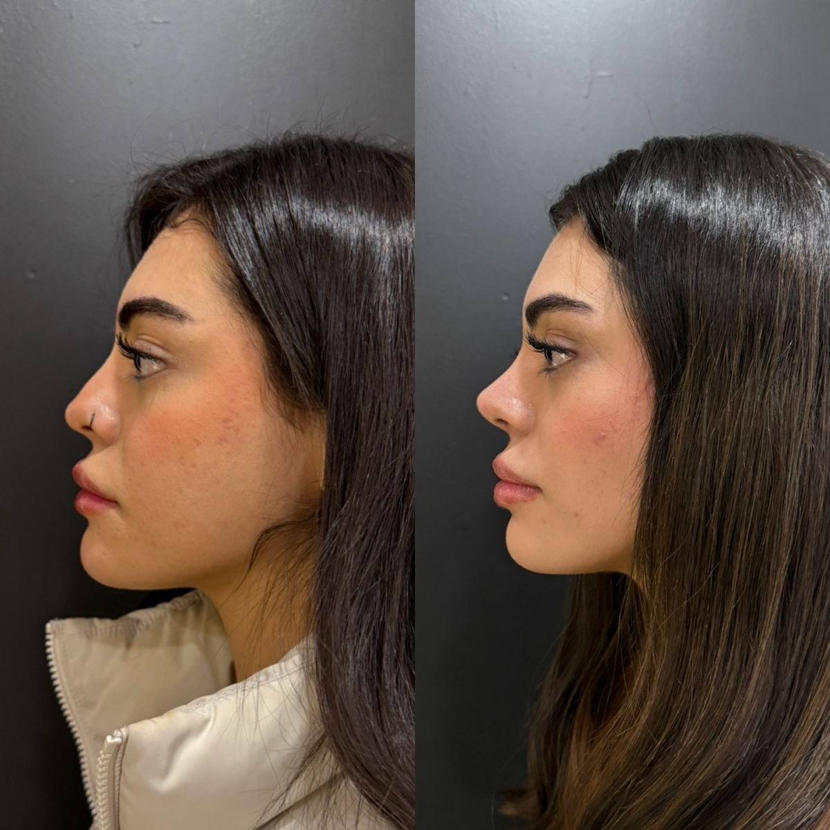 Resultados de rinoplastia antes y después, perfil y contorno nasal mejorados tras cirugía