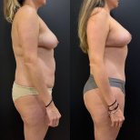 Before and after tummy tuck results – visible abdominal contour improvement in female patient