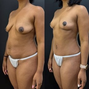 Before and after tummy tuck results – improved abdominal contour and tighter skin