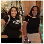 Before and after gastric bypass at Dr. Enrique Pliego Private Practice, visible weight loss result