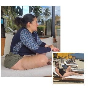 Before and after gastric bypass results at Dr. Enrique Pliego Private Practice, visible weight loss